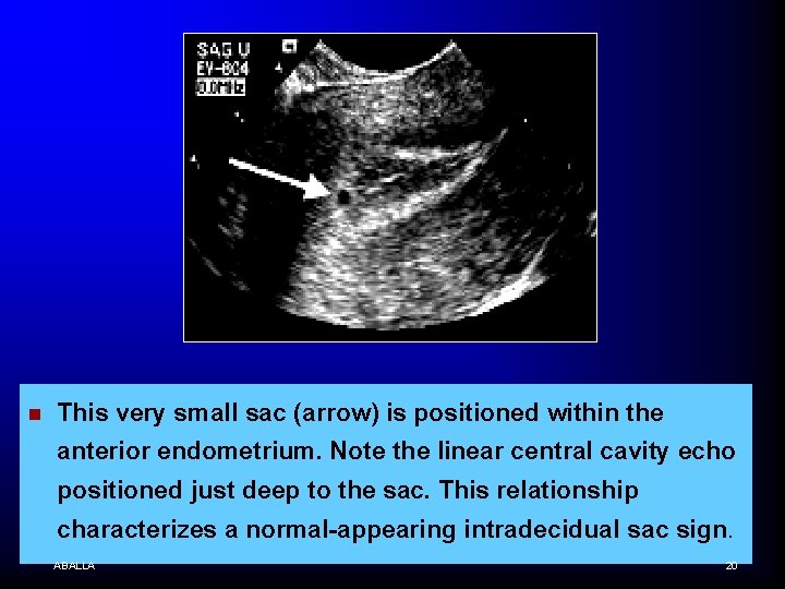 n This very small sac (arrow) is positioned within the anterior endometrium. Note the