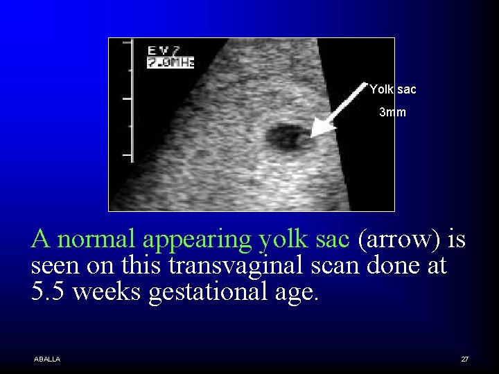 Yolk sac 3 mm A normal appearing yolk sac (arrow) is seen on this