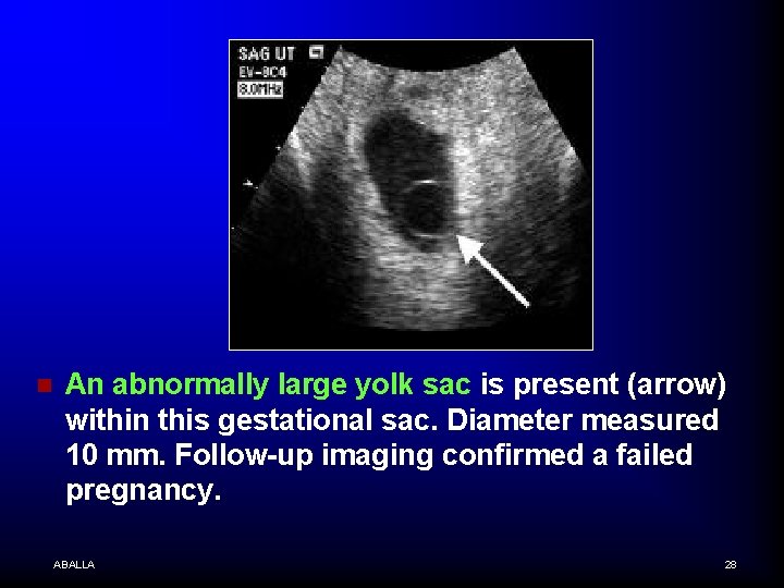 n An abnormally large yolk sac is present (arrow) within this gestational sac. Diameter