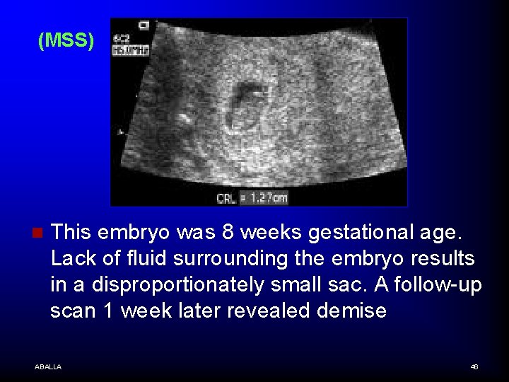 (MSS) n This embryo was 8 weeks gestational age. Lack of fluid surrounding the