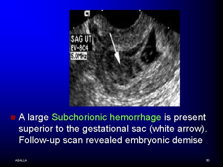 n A large Subchorionic hemorrhage is present superior to the gestational sac (white arrow).