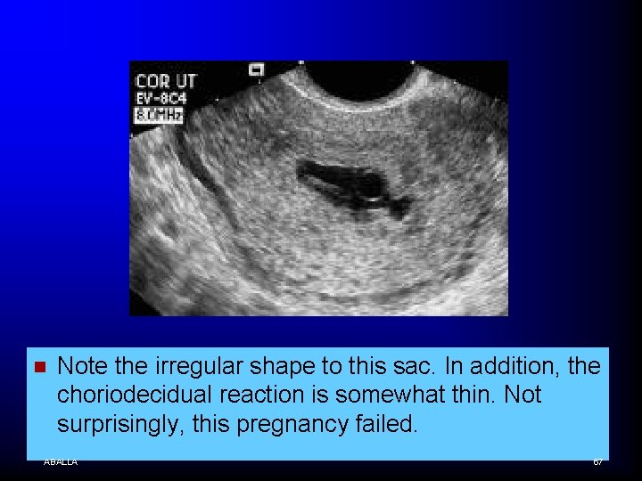 n Note the irregular shape to this sac. In addition, the choriodecidual reaction is