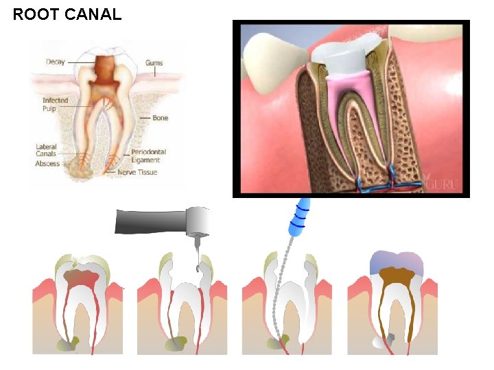 ROOT CANAL 