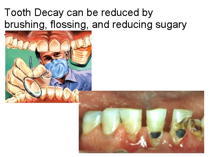 Tooth Decay can be reduced by brushing, flossing, and reducing sugary foods. 