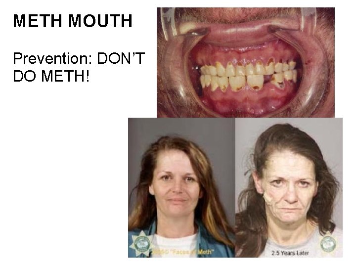 METH MOUTH Prevention: DON’T DO METH! 