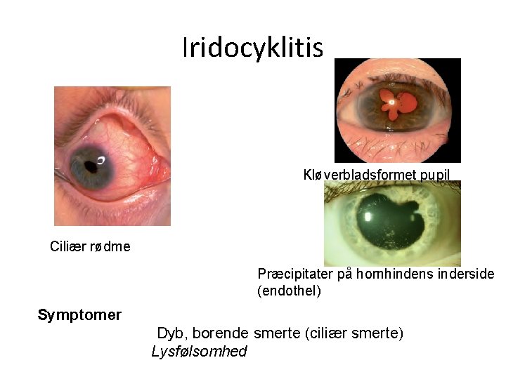 Iridocyklitis Kløverbladsformet pupil Ciliær rødme Præcipitater på hornhindens inderside (endothel) Symptomer Dyb, borende smerte