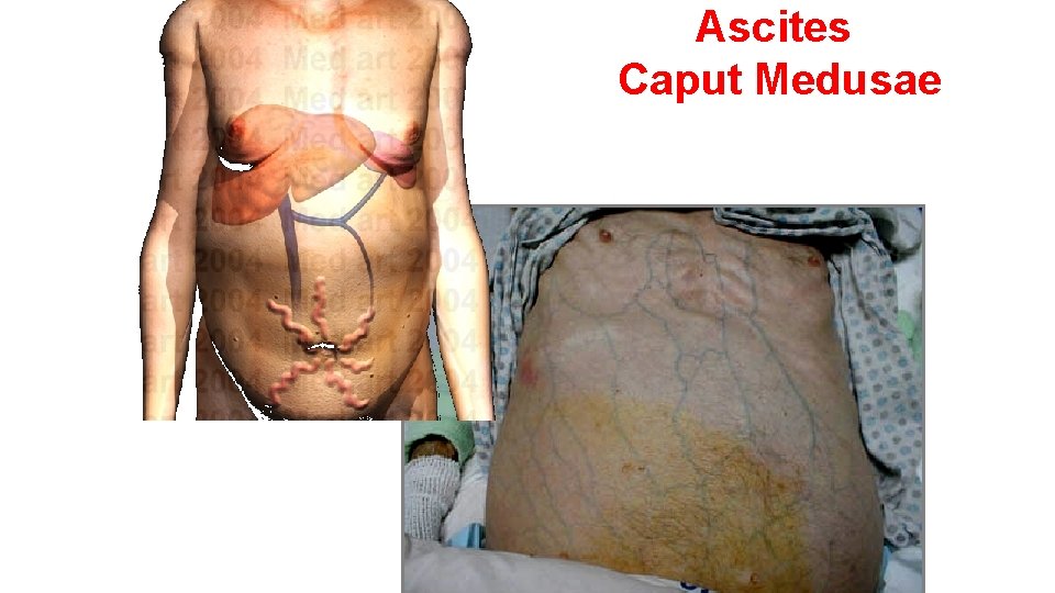 Ascites Caput Medusae 