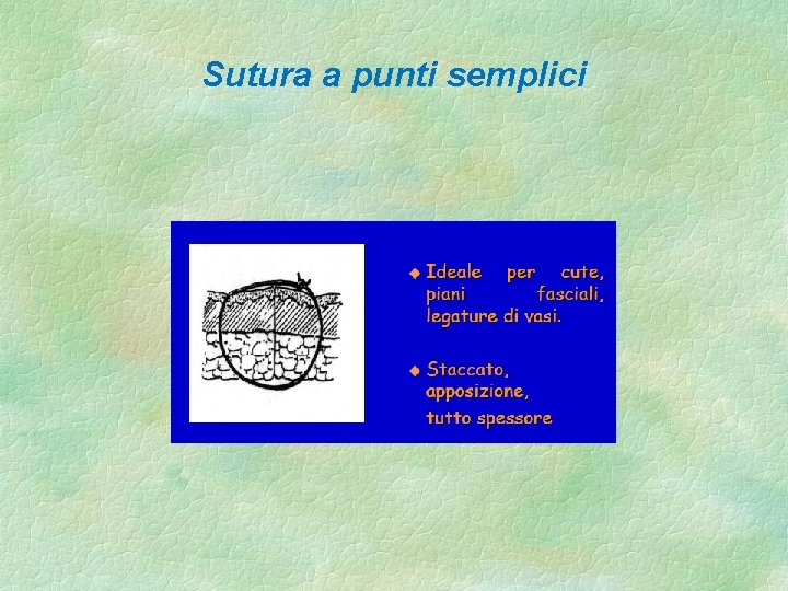 Sutura a punti semplici 