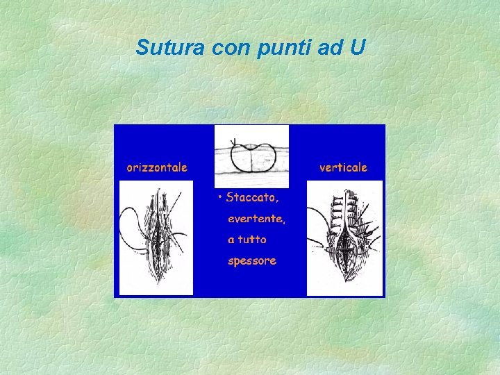 Sutura con punti ad U 