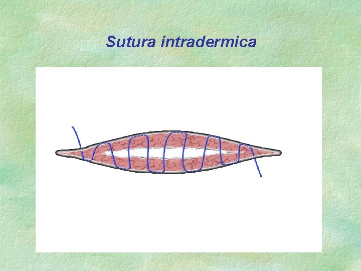 Sutura intradermica 