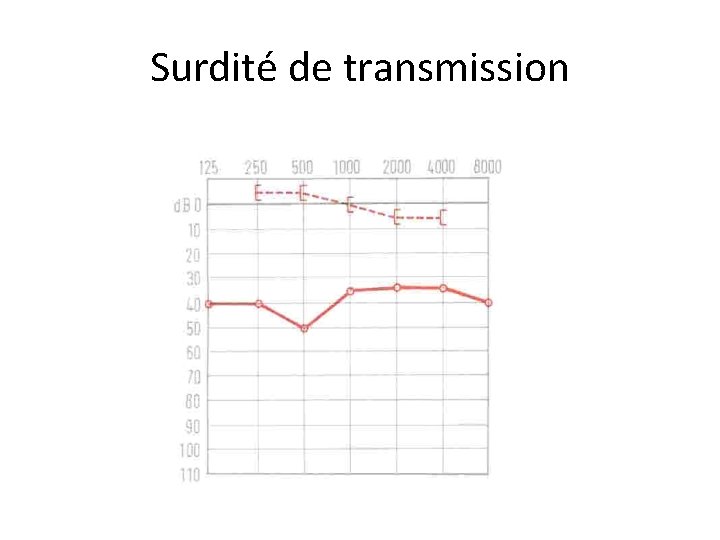 Surdité de transmission 