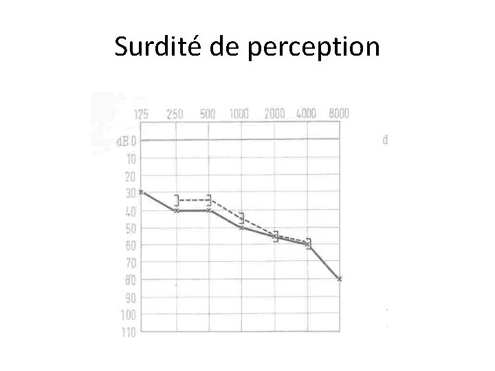 Surdité de perception 