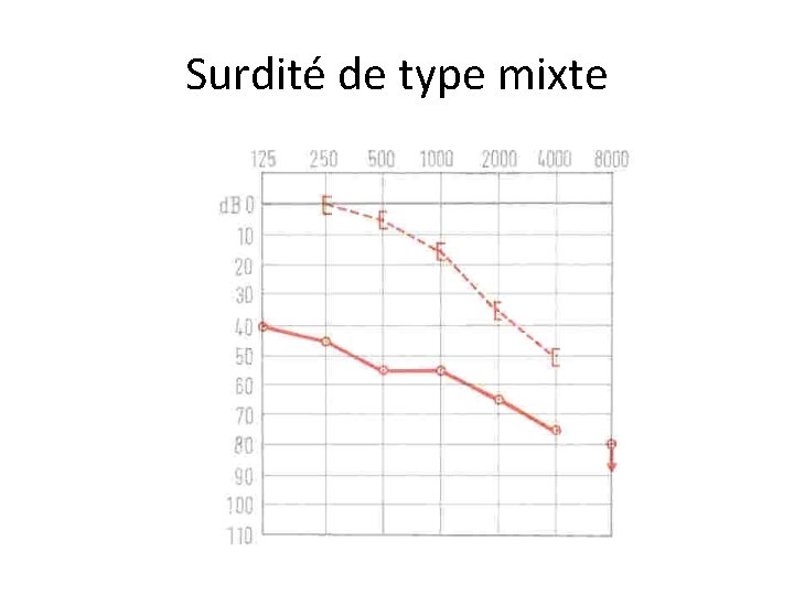 Surdité de type mixte 