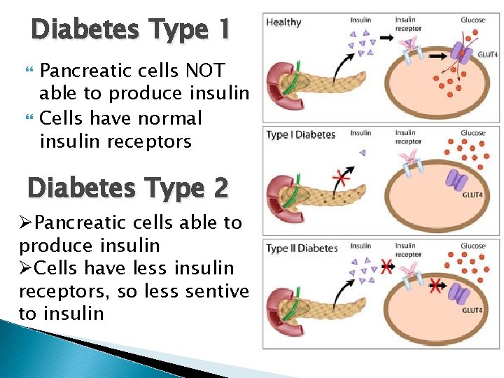Diabetes Type 1 Pancreatic cells NOT able to produce insulin Cells have normal insulin