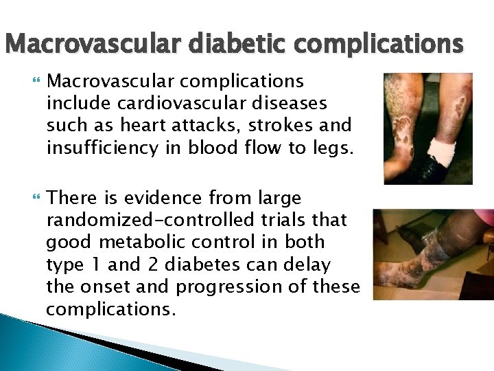 Macrovascular diabetic complications Macrovascular complications include cardiovascular diseases such as heart attacks, strokes and