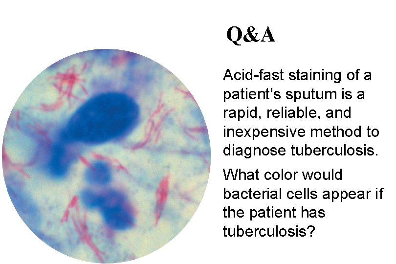 Q&A Acid-fast staining of a patient’s sputum is a rapid, reliable, and inexpensive method