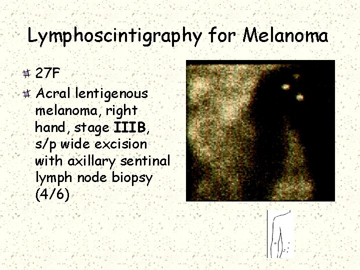 Lymphoscintigraphy for Melanoma 27 F Acral lentigenous melanoma, right hand, stage IIIB, s/p wide
