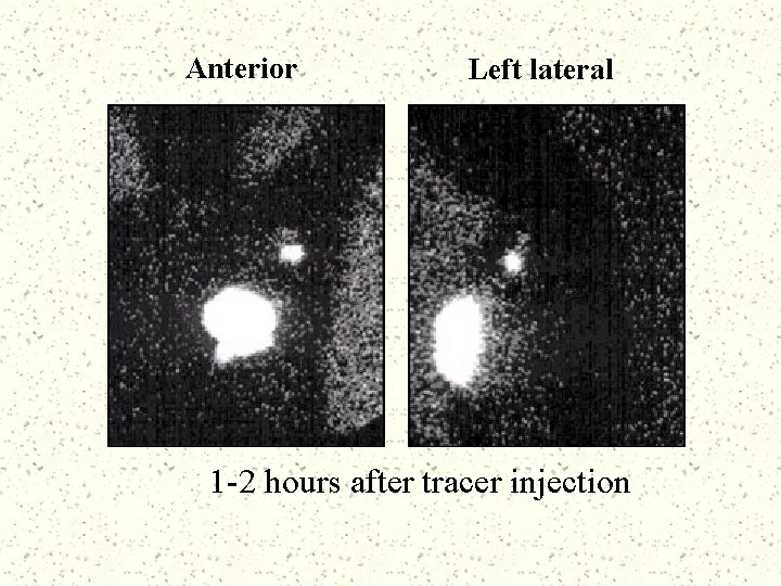 Anterior Left lateral 1 -2 hours after tracer injection 