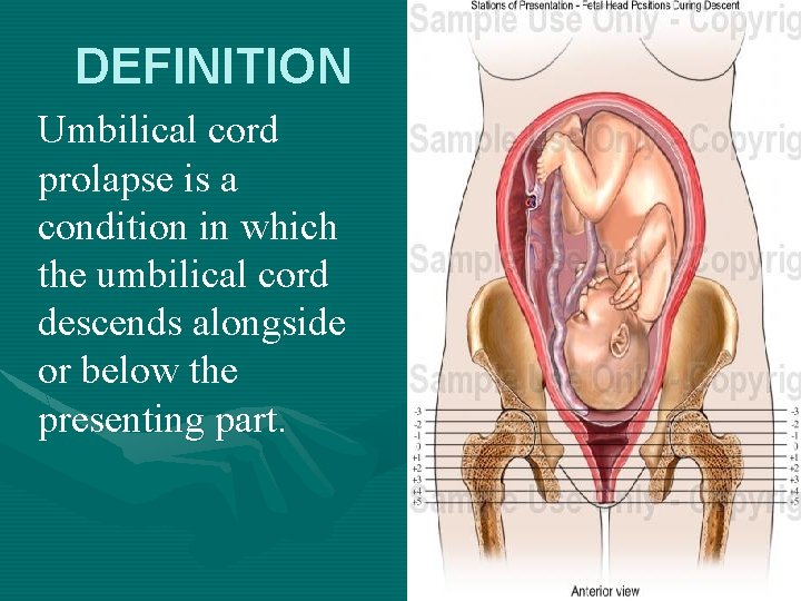DEFINITION Umbilical cord prolapse is a condition in which the umbilical cord descends alongside