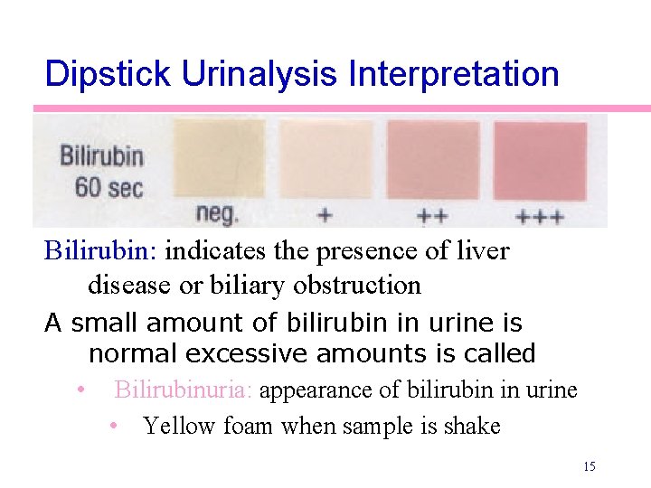 Dipstick Urinalysis Interpretation Bilirubin: indicates the presence of liver disease or biliary obstruction A