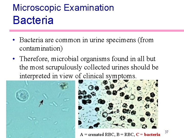Microscopic Examination Bacteria • Bacteria are common in urine specimens (from contamination) • Therefore,