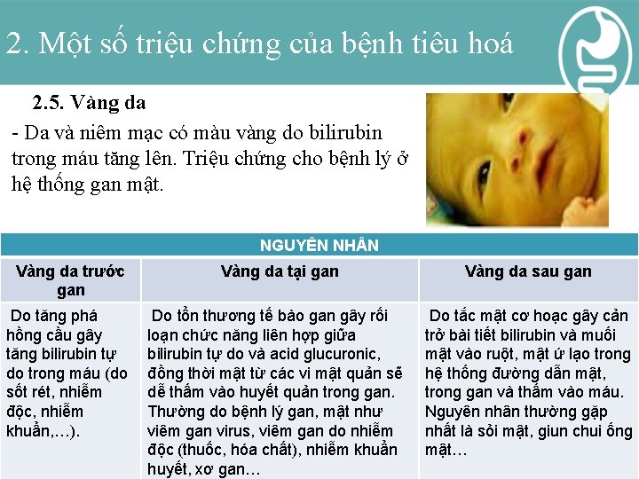 2. Một số triệu chứng của bệnh tiêu hoá 2. 5. Vàng da -