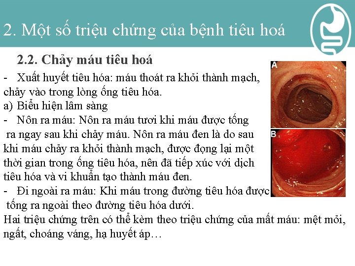 2. Một số triệu chứng của bệnh tiêu hoá 2. 2. Chảy máu tiêu