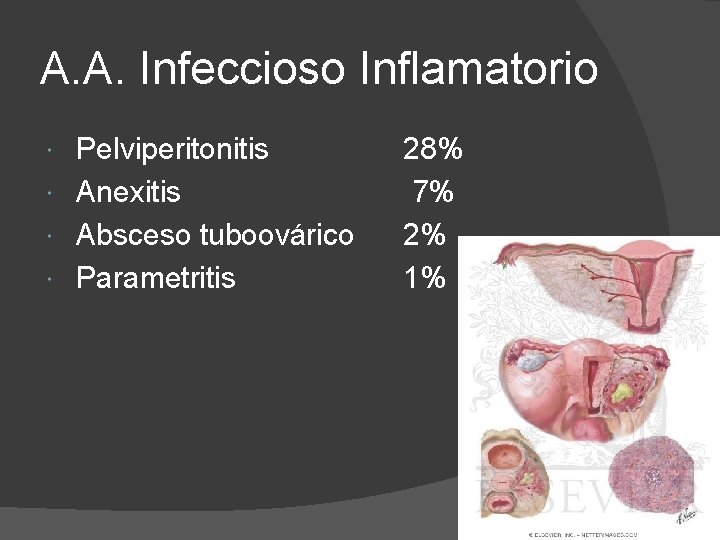 A. A. Infeccioso Inflamatorio Pelviperitonitis Anexitis Absceso tuboovárico Parametritis 28% 7% 2% 1% 