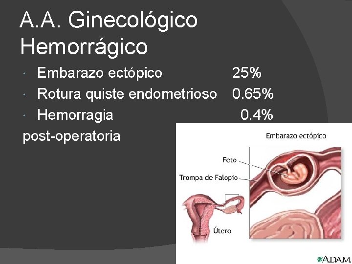 A. A. Ginecológico Hemorrágico Embarazo ectópico Rotura quiste endometrioso Hemorragia post-operatoria 25% 0. 65%