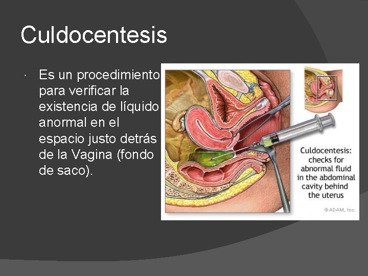 Culdocentesis Es un procedimiento para verificar la existencia de líquido anormal en el espacio