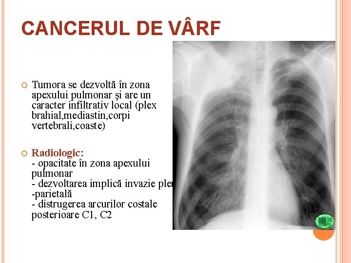 CANCERUL DE V RF Tumora se dezvoltă în zona apexului pulmonar şi are un