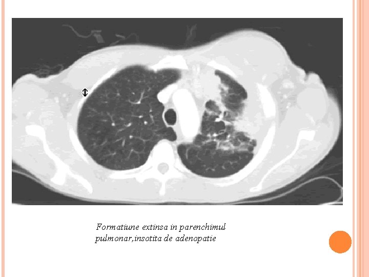 Formatiune extinsa in parenchimul pulmonar, insotita de adenopatie 