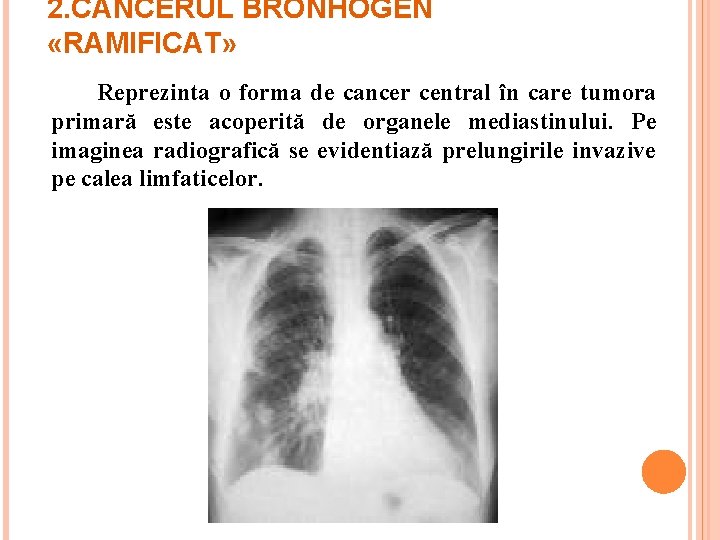 2. CANCERUL BRONHOGEN «RAMIFICAT» Reprezinta o forma de cancer central în care tumora primară