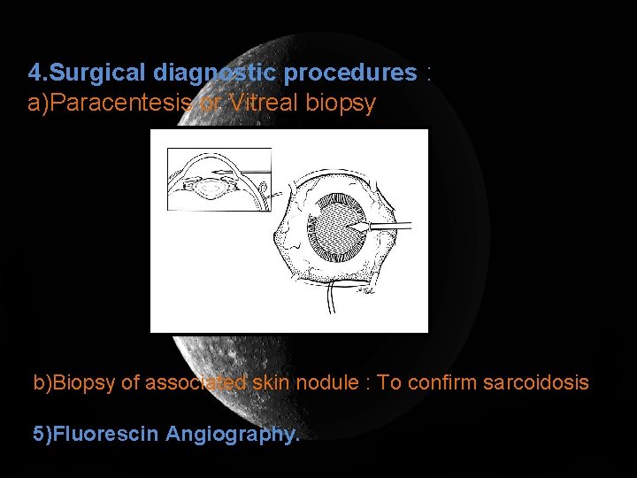4. Surgical diagnostic procedures : a)Paracentesis or Vitreal biopsy b)Biopsy of associated skin nodule
