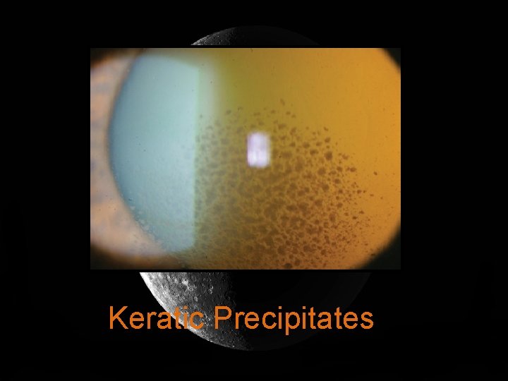 Keratic Precipitates 