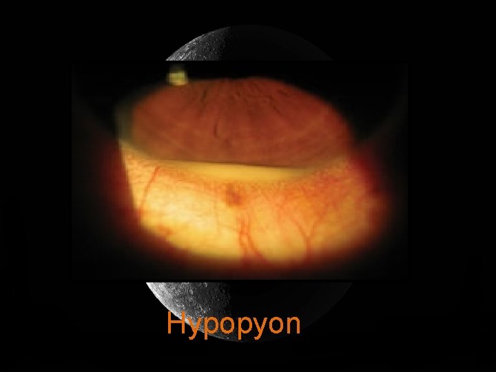 Hypopyon 