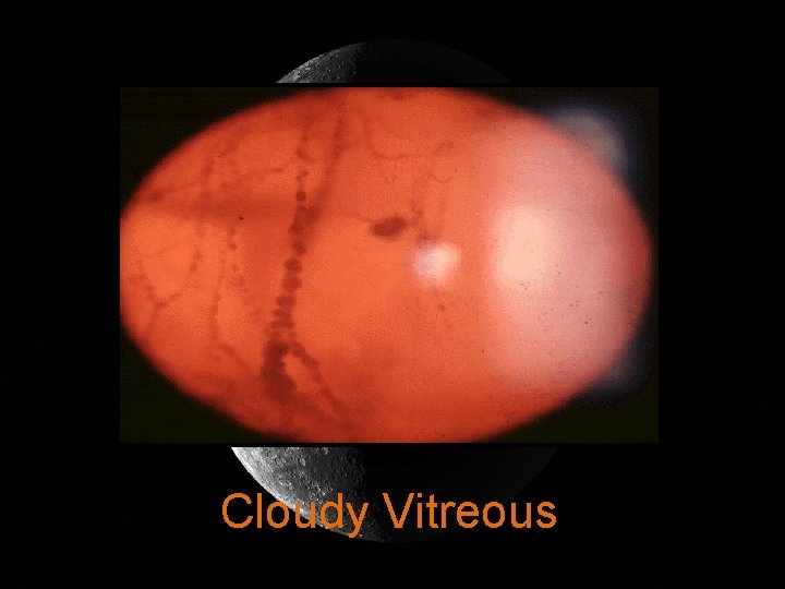 Cloudy Vitreous 