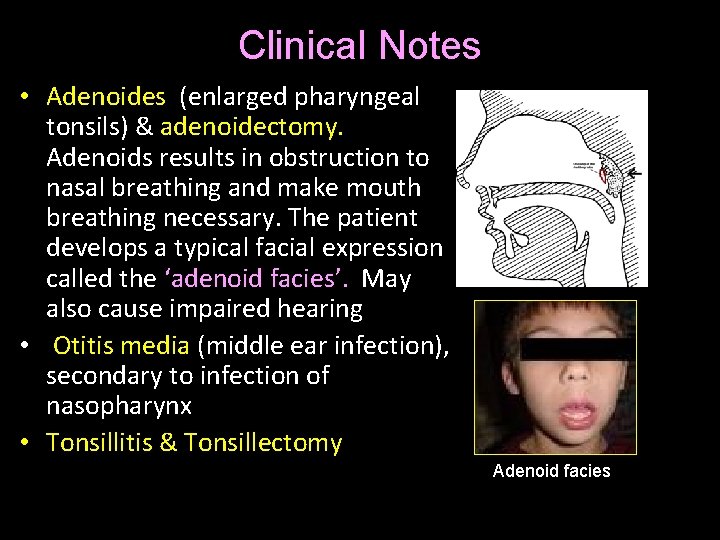 Clinical Notes • Adenoides (enlarged pharyngeal tonsils) & adenoidectomy. Adenoids results in obstruction to