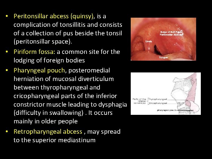  • Peritonsillar abcess (quinsy), is a complication of tonsillitis and consists of a