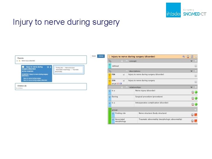 Injury to nerve during surgery 