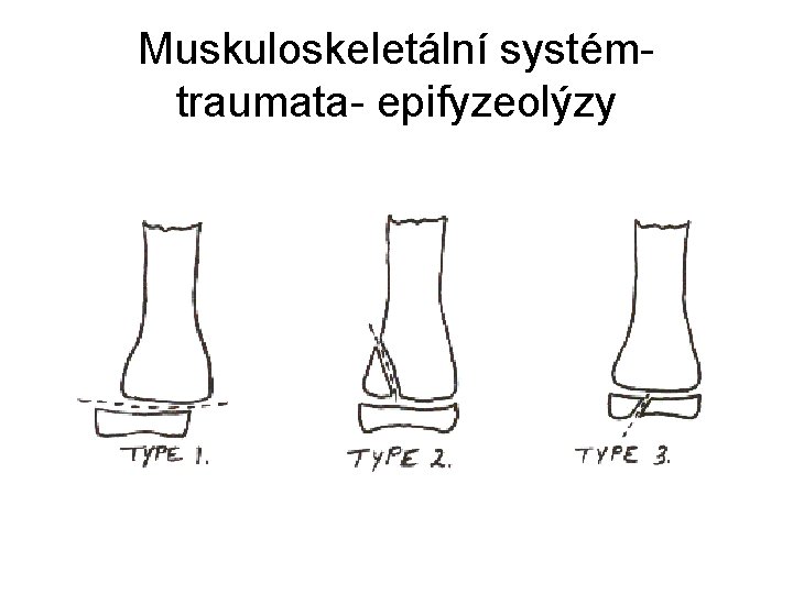 Muskuloskeletální systémtraumata- epifyzeolýzy 