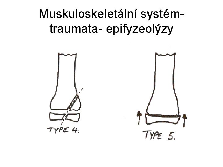 Muskuloskeletální systémtraumata- epifyzeolýzy 