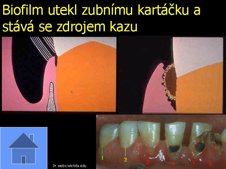 Biofilm utekl zubnímu kartáčku a stává se zdrojem kazu 3× webs. wichita. edu 