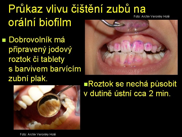 Průkaz vlivu čištění zubů na orální biofilm Foto: Archiv Veroniky Holé n Dobrovolník má