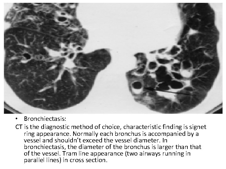  • Bronchiectasis: CT is the diagnostic method of choice, characteristic finding is signet