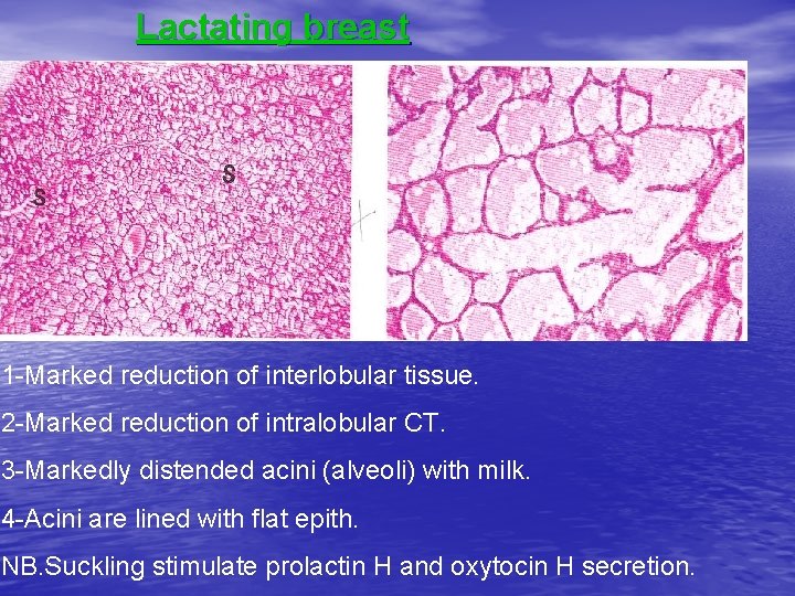 Lactating breast 1 -Marked reduction of interlobular tissue. 2 -Marked reduction of intralobular CT.