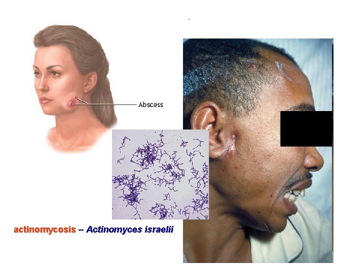 actinomycosis – Actinomyces israelii 