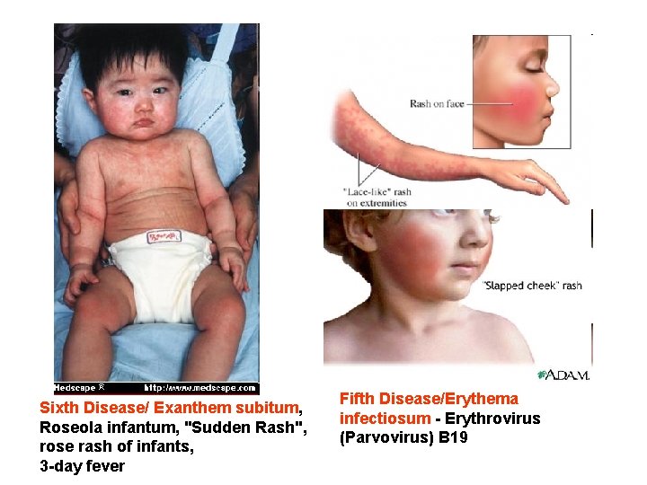 Sixth Disease/ Exanthem subitum, Roseola infantum, "Sudden Rash", rose rash of infants, 3 -day
