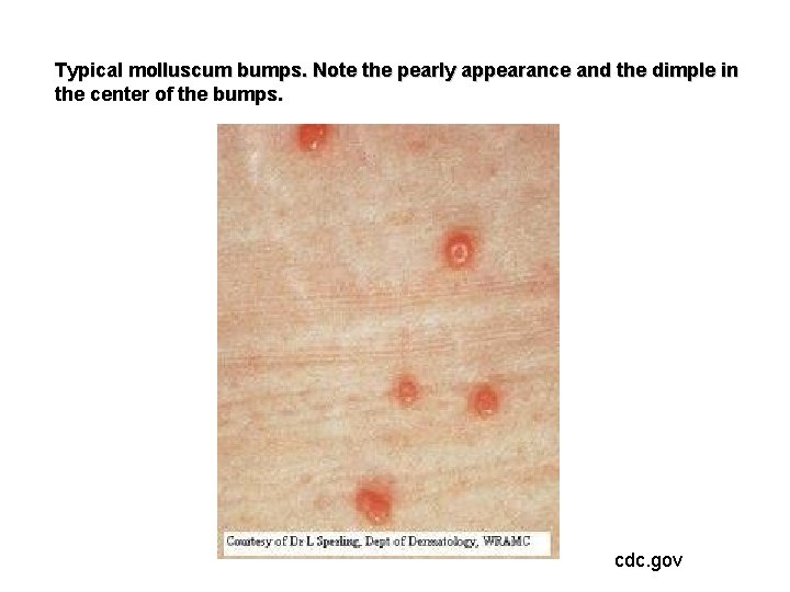 Typical molluscum bumps. Note the pearly appearance and the dimple in the center of