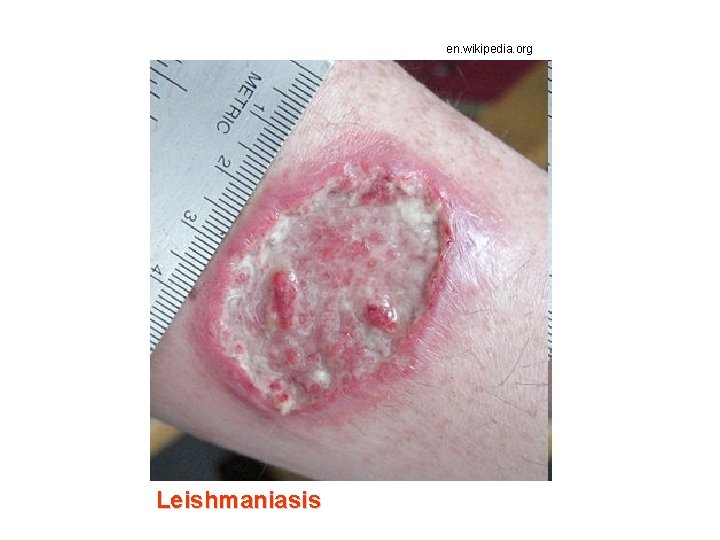 en. wikipedia. org Leishmaniasis 